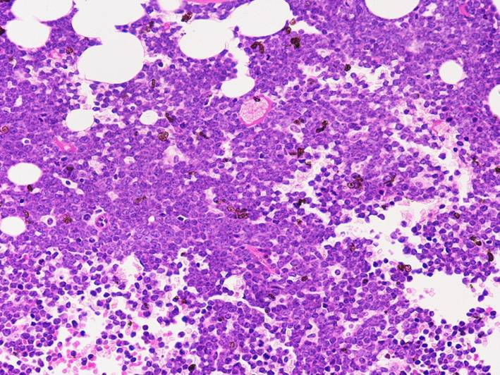third bone marrow biopsy